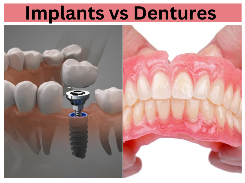 implants vs Dentures