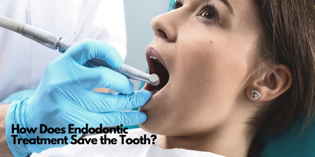 How Does Endodontic Treatment Save the Tooth