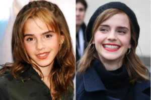 Emma Watson Dentures
