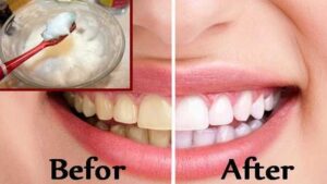 tooth whitening