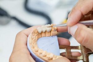 How Long Does a Dental Bridge Last