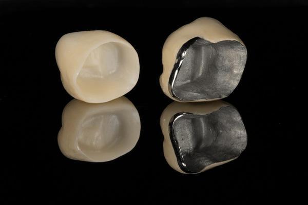 Types of Dental Crowns