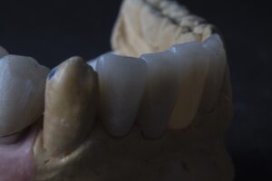 crown after root canal