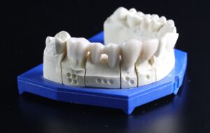 dental bridge vs implant