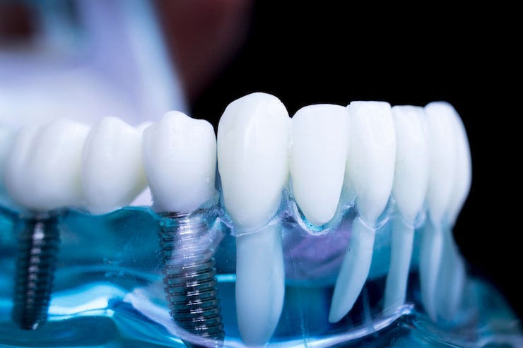 dental implants near me
