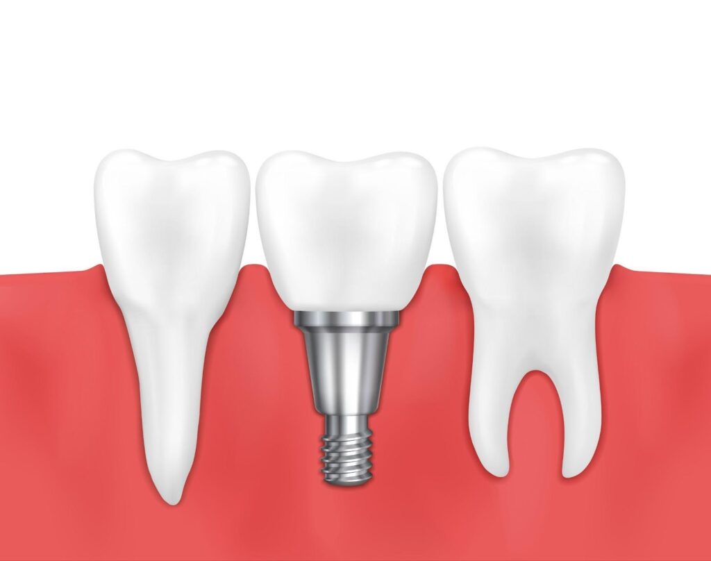 implants dental near me