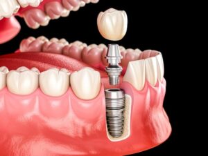 dental implants in one day