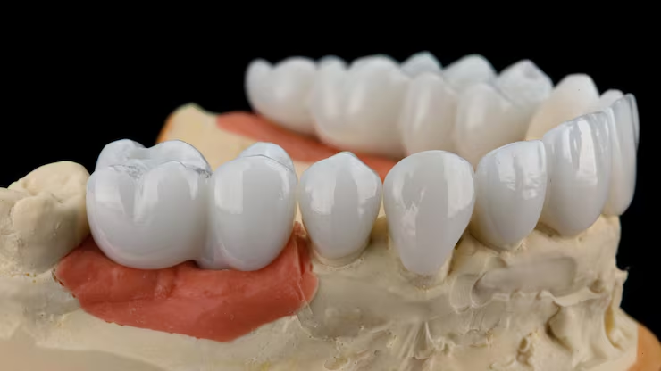 ceramic teeth caps