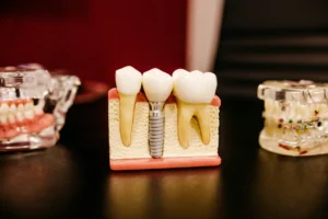 types of dental implants